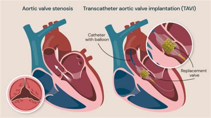 My Scar Aortic valve replacement, Open heart surgery, Heart surgery