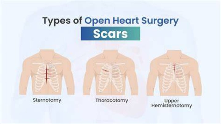 Open Heart Surgery Scar Healing How to care scars Miami, FL